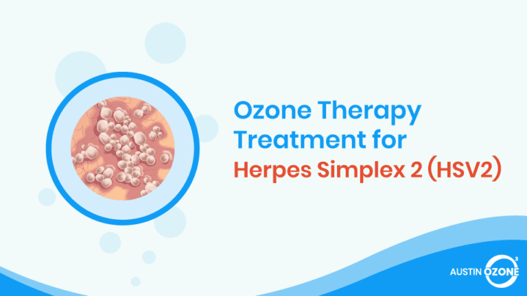 Ozone Therapy for Herpes Simplex 2