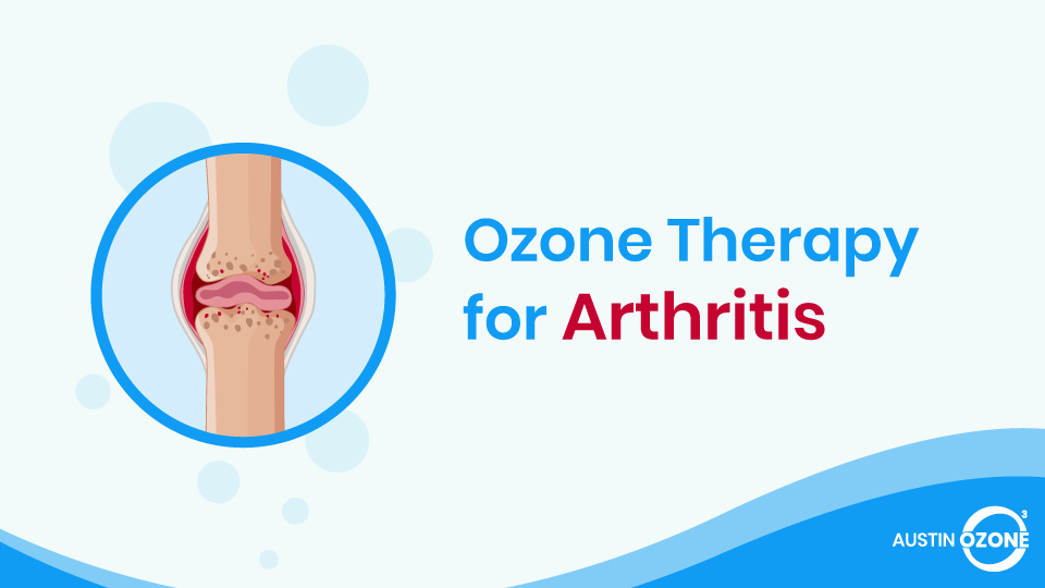 Ozone Therapy for Rheumatoid Arthritis