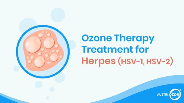 Ozone Therapy for Herpes | Ozone Therapy for HSV-1 & HSV-2